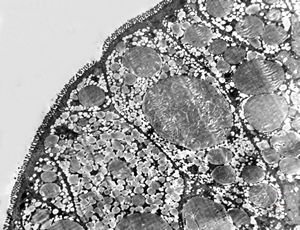 celiakia … reduced microvilli, lipid droplets